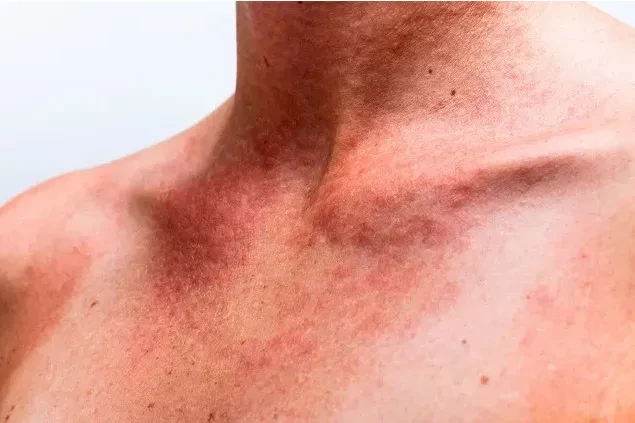 7 nguyên nhân gây sưng tấy trên cơ thể