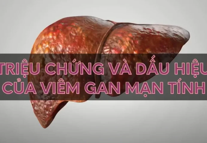 Triệu chứng và dấu hiệu của viêm gan mạn tính