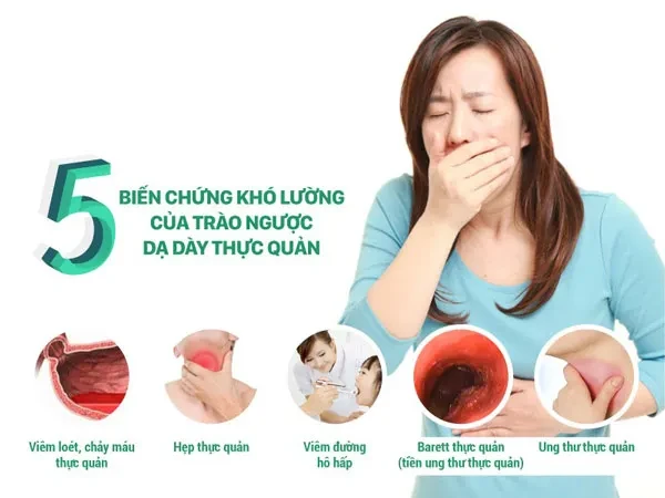 5 biến chứng nguy hiểm của trào ngược dạ dày – thực quản