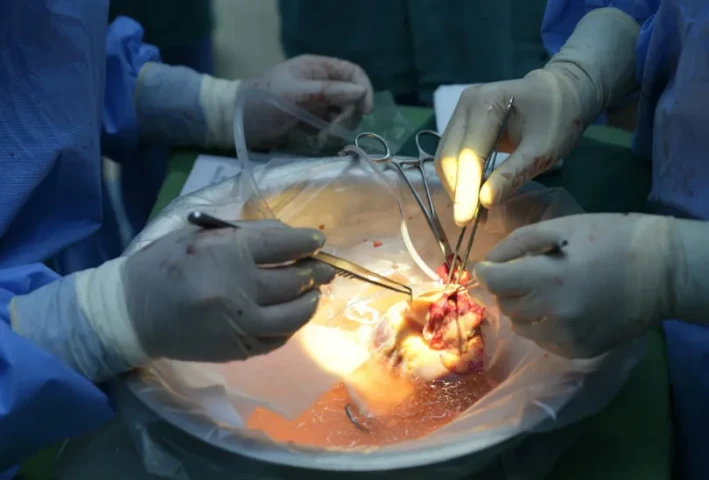 Lần đầu tiên tại Việt Nam: Ghép tim cho bệnh nhân đã cấy dụng cụ hỗ trợ thất trái