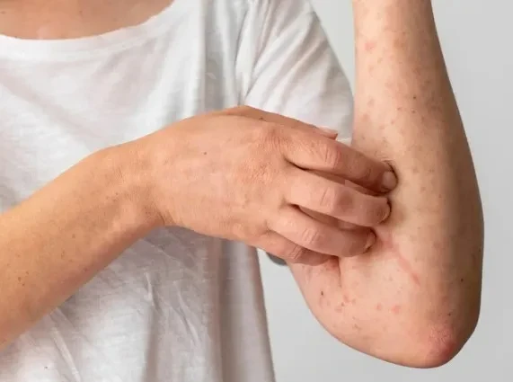 Những điều cần biết về viêm da cơ địa ở người lớn