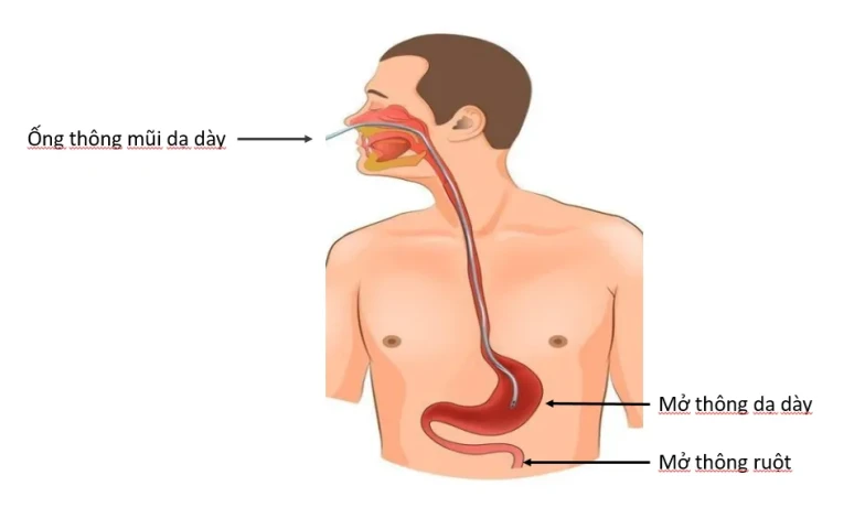 Hướng dẫn chế biến súp cho người bệnh nuôi ăn qua ống thông