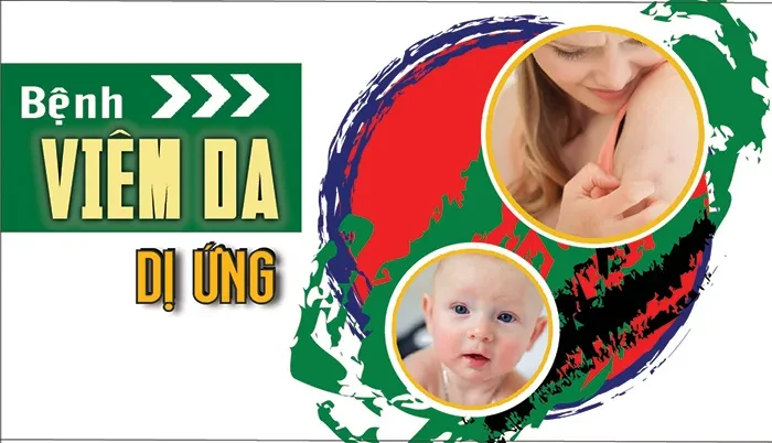 Bệnh viêm da dị ứng