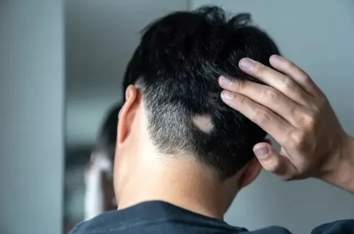 Nguyên nhân, triệu chứng rụng tóc từng vùng