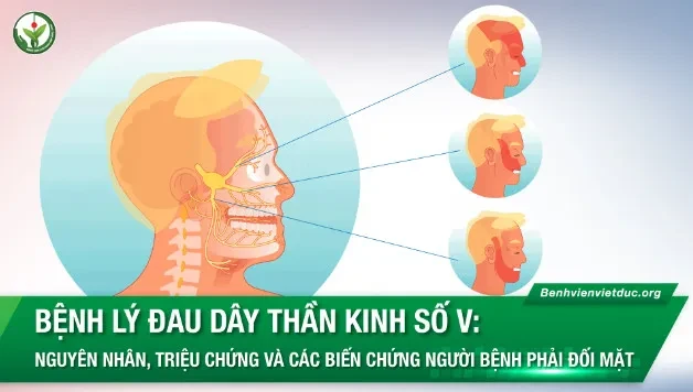 Nguyên nhân, triệu chứng và các biến chứng của bệnh lý đau dây thần kinh số V