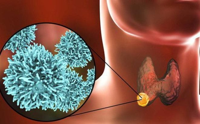 Các phương pháp điều trị ung thư tuyến giáp