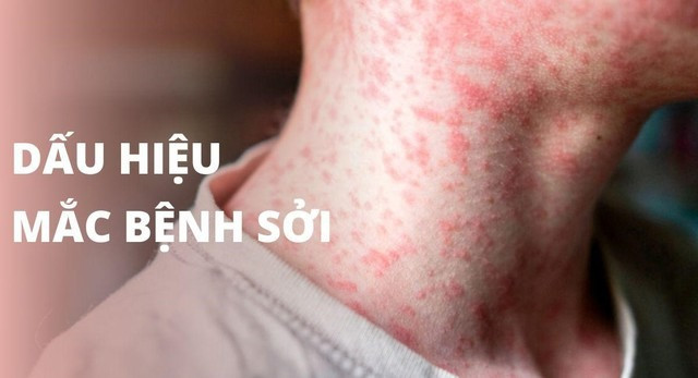 Tăng cường công tác phòng, chống dịch, bệnh sởi trên địạ bàn TP. Hà Nội