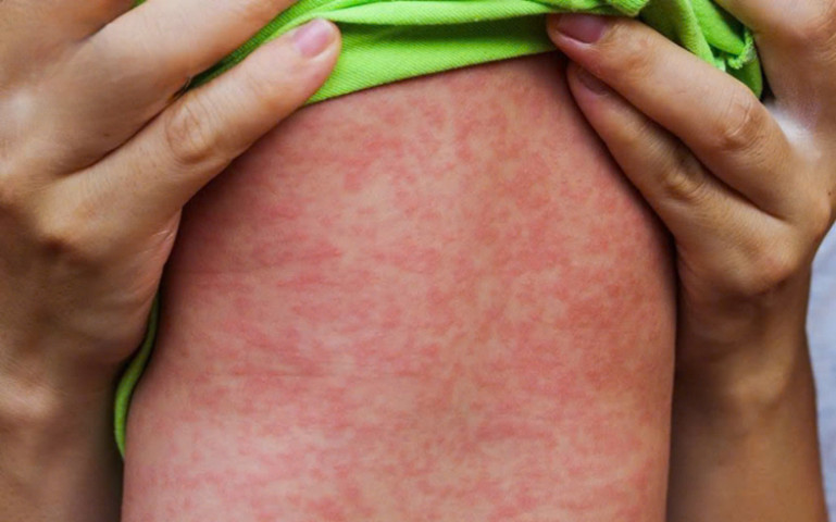Không nên chủ quan khi mắc bệnh sởi
