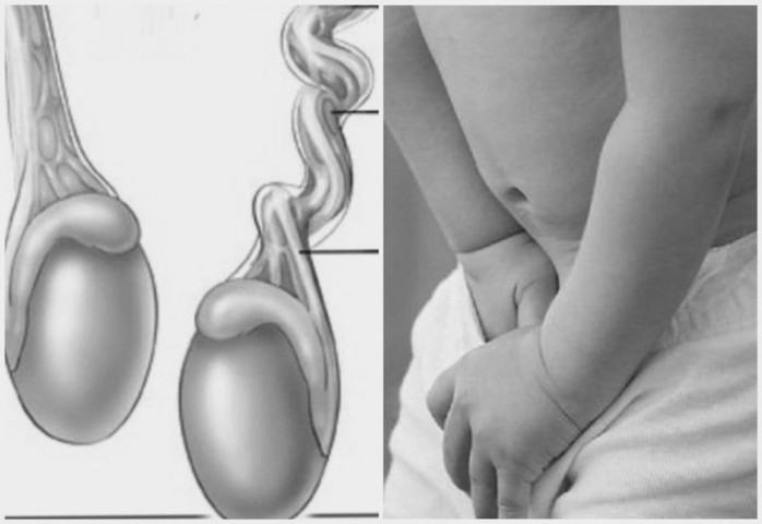 Nam thanh niên phải cắt tinh hoàn do đau nhưng không đi khám sớm
