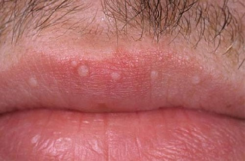 HPV ở nam giới - những điều cần biết