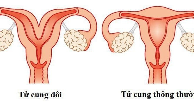 Bệnh tử cung đôi là gì?