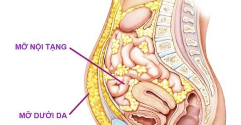Loại bỏ thủ phạm gây mỡ nội tạng
