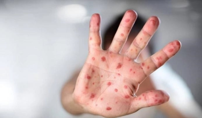 Bà Rịa - Vũng Tàu: Đã có trường hợp tử vong do bệnh sởi