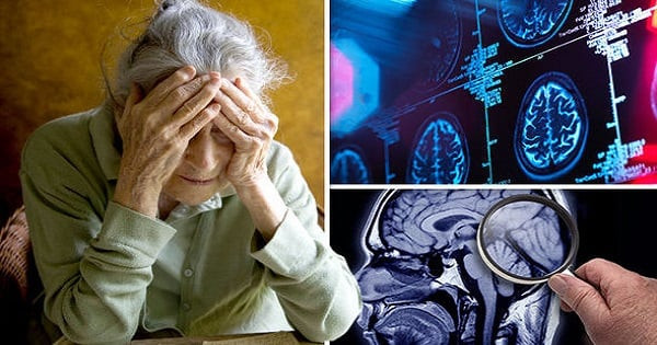 Sa sút trí tuệ trong bệnh Alzheimer