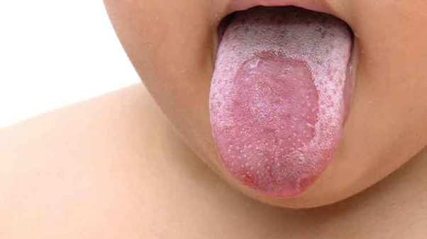 Lưỡi bản đồ: Nguyên nhân, triệu chứng và cách điều trị hiệu quả