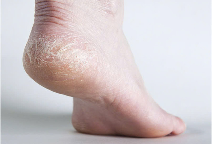 Nứt gót chân mùa đông: Nguyên nhân và giải pháp hiệu quả