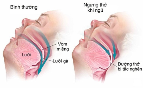 Nhận biết mắc hội chứng ngưng thở khi ngủ