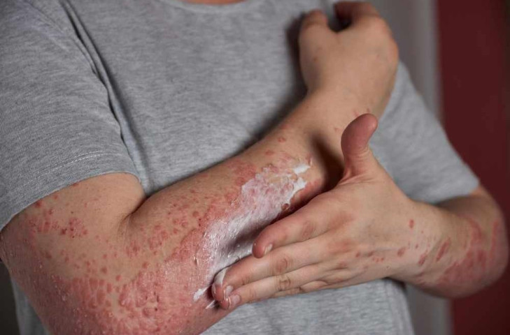 Ai dễ mắc bệnh viêm da dị ứng?
