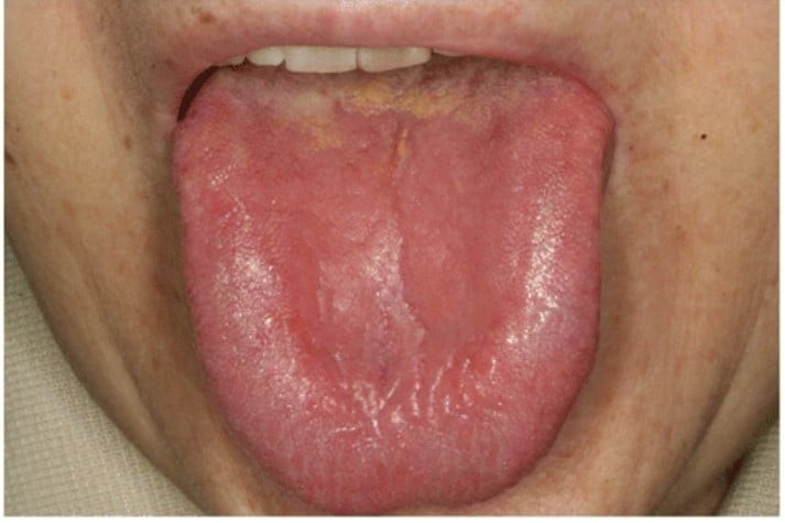 Hội chứng miệng bỏng rát (Burning mouth syndrome)