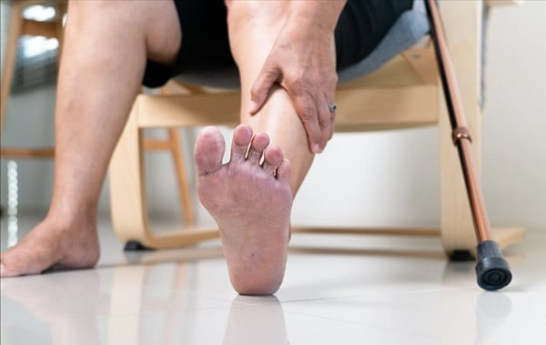 Cụ bà bị hoại tử đầu chi do bệnh động mạch chi dưới
