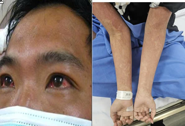Cảnh báo bệnh nhiễm xoắn khuẩn do Leptospira ở trẻ em