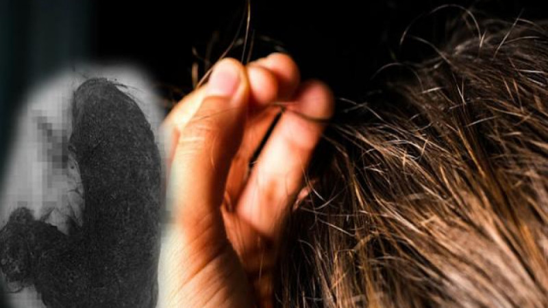 Nghệ An: Hai bé gái nhập viện vì ăn tóc