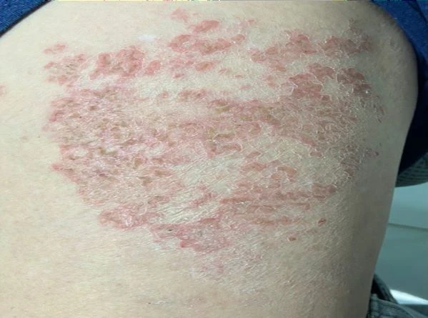 Cảnh giác với bệnh ấu trùng giun đũa chó lây sang người
