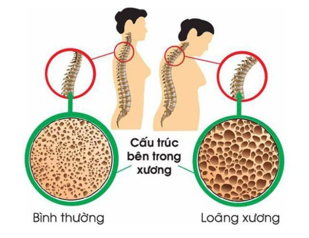 Mối nguy hiểm tiềm ẩn khi phụ nữ thiếu canxi