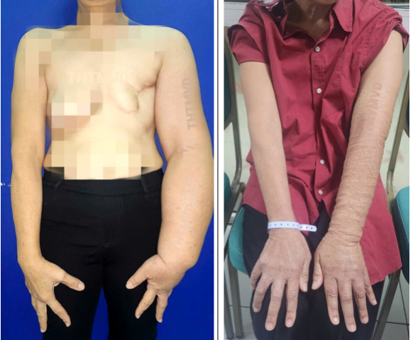 Điều trị thành công phù bạch mạch cánh tay kết hợp tái tạo vú sau cắt bỏ do ung thư