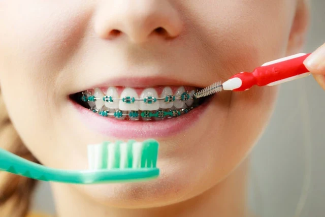 Một số lưu ý khi niềng răng để hàm răng luôn trắng khoẻ