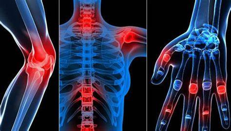 Dấu hiệu cảnh báo sớm bệnh viêm khớp ở phụ nữ
