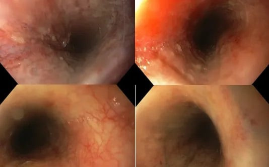 Hà Tĩnh: Cấp cứu bệnh nhi 20 tháng tuổi uống nhầm dung dịch kiềm tẩy rửa mốc