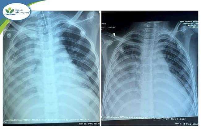 Điều trị thành công cho bệnh nhi 9 tuổi người Ấn Độ bị viêm phổi hoại tử, viêm mủ màng phổi, nhiễm khuẩn huyết