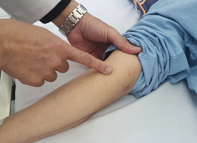 Nhiễm não mô cầu có thể tử vong trong 24h