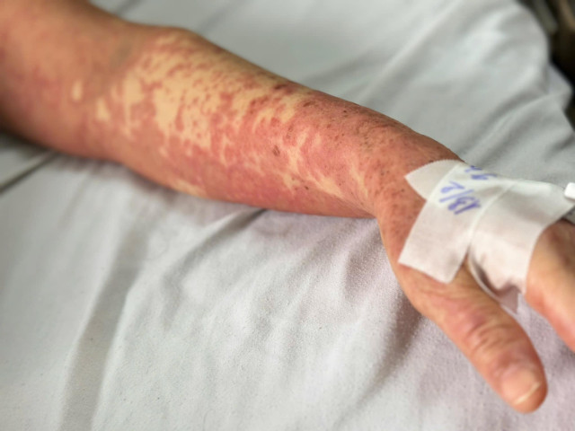 Hà Nội: Điều trị tích cực cho cụ bà bị dị ứng thuốc nặng khiến toàn thân mẩn ngứa và men gan tăng cao