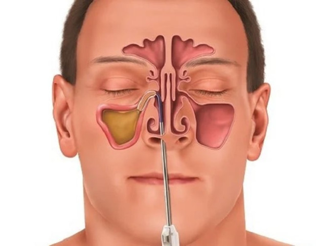 Tự ý điều trị viêm xoang có thể dẫn đến biến chứng nguy hiểm