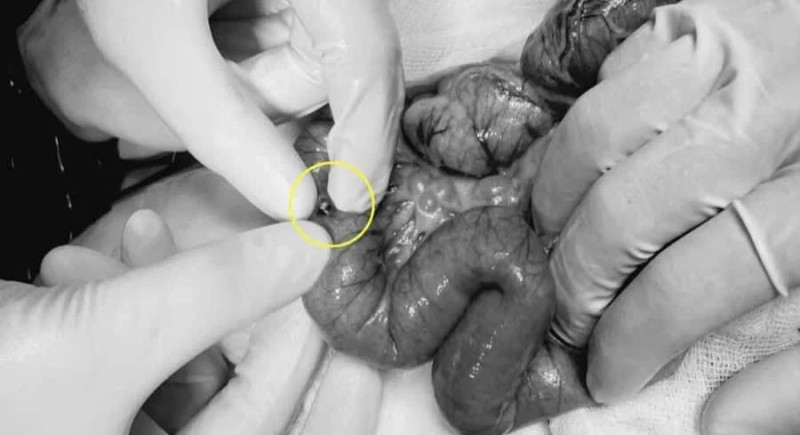 TP Hồ Chí Minh: Bệnh nhi 4 tuổi phải cắt ruột do nuốt 15 viên nam châm