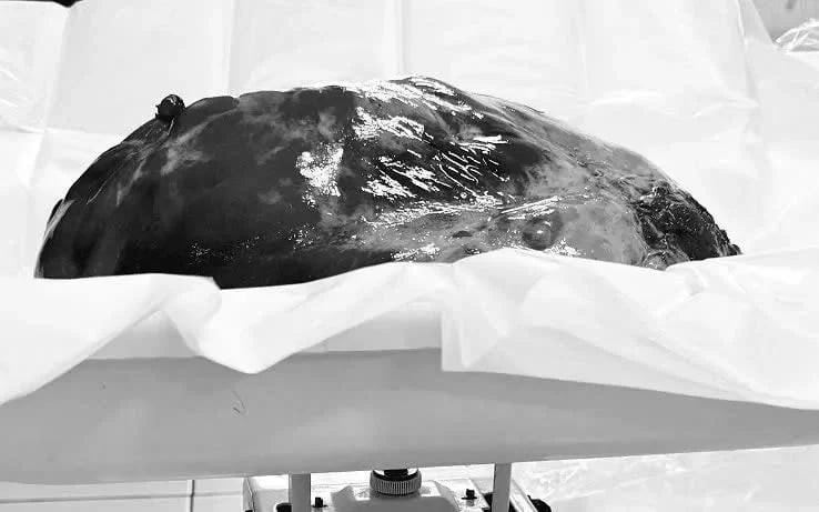 Hà Nội: Cắt thành công khối u nặng 3.6kg cho người đàn ông 42 tuổi