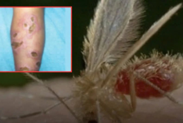 Thái Lan: Cảnh báo bệnh nhiễm ký sinh trùng Leishmania gây tử vong