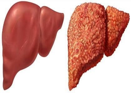 Thủ phạm khiến men gan tăng cao mà nhiều người vẫn vô tư sử dụng