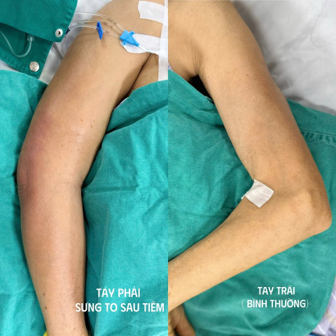 Hà Nội: Nữ bệnh nhân sốc nhiễm khuẩn nặng sau tiêm khớp vai tại phòng khám tư