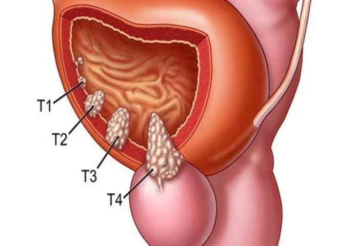 Bài thuốc hỗ trợ điều trị bệnh ung thư bàng quang