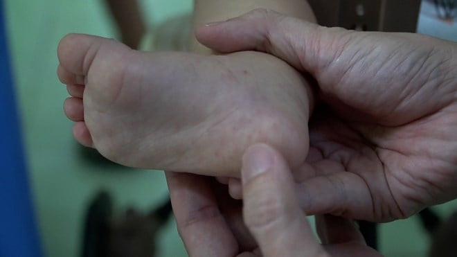Việt Nam thử nghiệm vaccine tay chân miệng đạt hiệu lực 99,21%
