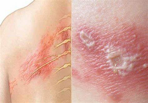 Những biến chứng nguy hiểm của bệnh zona thần kinh