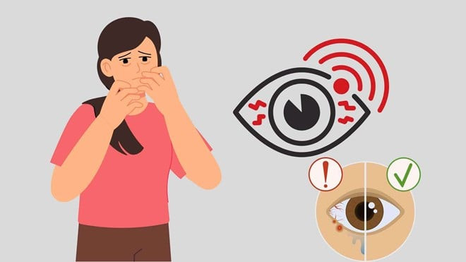Mộng thịt, căn bệnh thường gặp ở mắt không nên chủ quan
