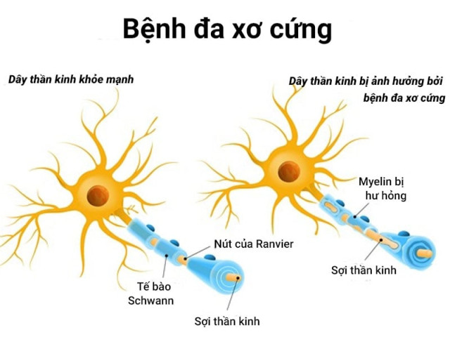 Độ tuổi nào dễ mắc bệnh đa xơ cứng