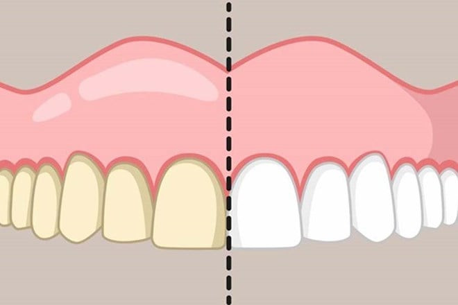 Sự thật việc làm trắng răng bằng hỗn hợp chanh, muối hột và dầu mù tạt