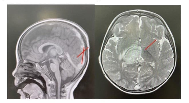 Bé trai mắc huyết khối tĩnh mạch nội sọ nặng do nguyên nhân hiếm gặp
