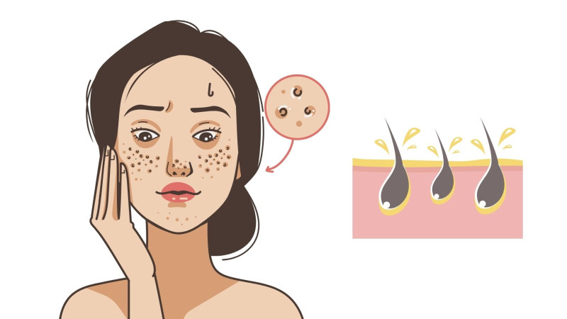 5 nguyên nhân phổ biến khiến lỗ chân lông ngày càng to hơn