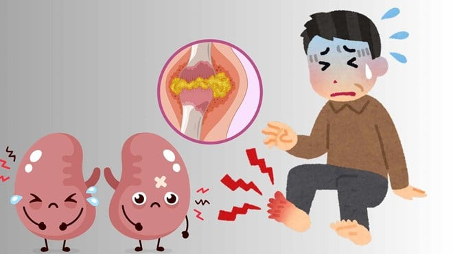 Mối liên hệ giữa bệnh gút và thận